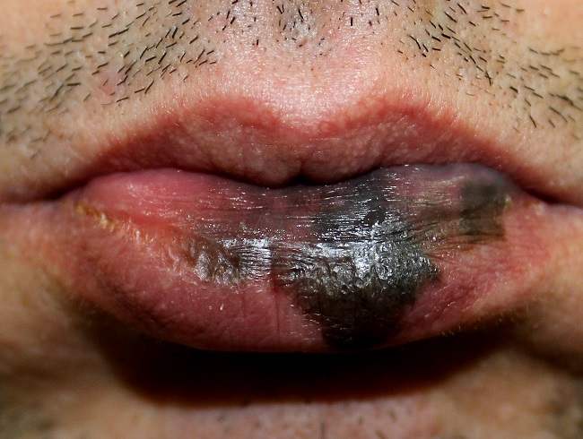 kanker-bibir Ilustrasi - Kangker bibir